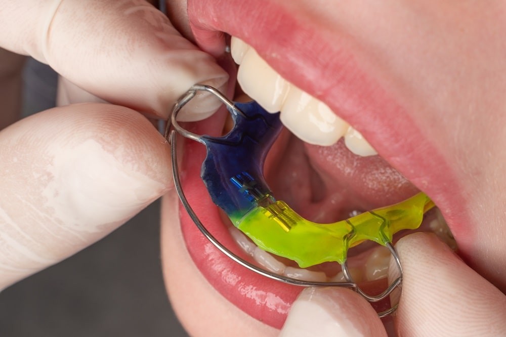 ارتودنسی فانکشنال کودکان در شهرکرد