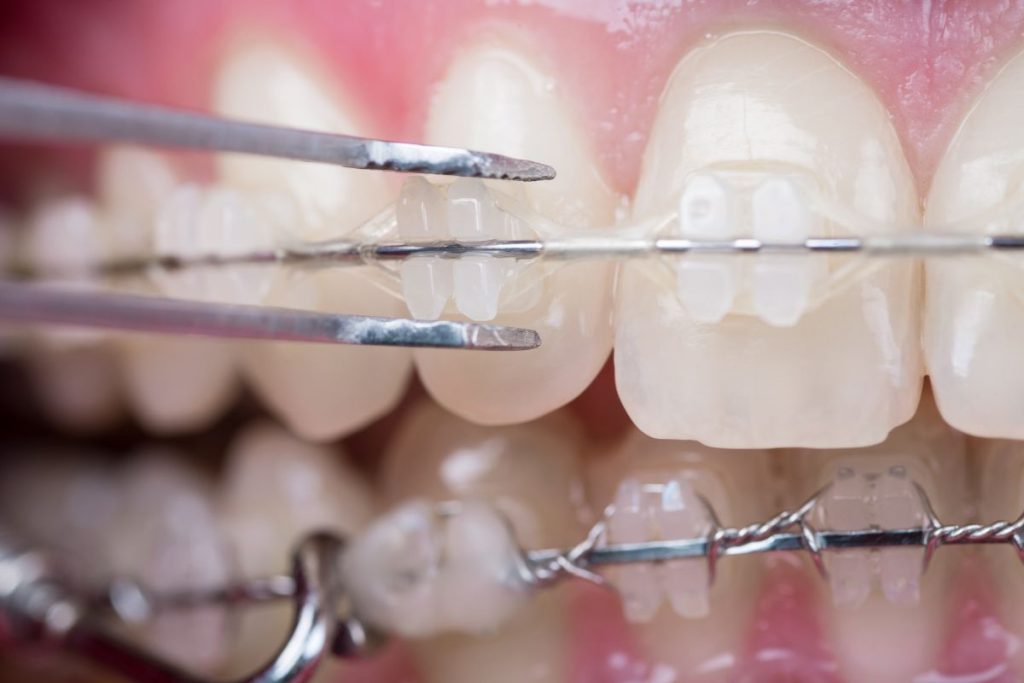 ارتودنسی سرامیکی