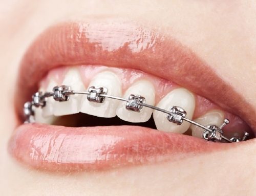 ارتودنسی دیمون در شهرکرد در ۳ مرحله | درمان مدرن نزد بهترین متخصص ارتودنسی