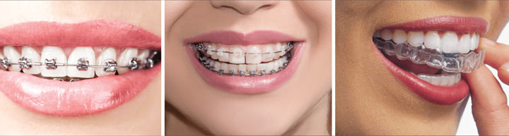 انواع بریس های ارتودنسی - مزایا
